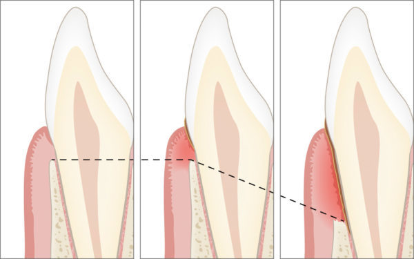 Was ist Parodontitis?