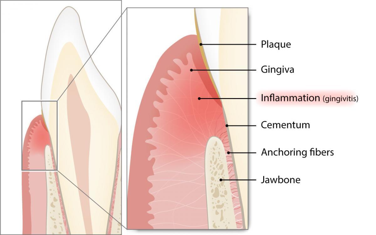 Was ist die Gingivitis und wie häufig kommt sie vor?
