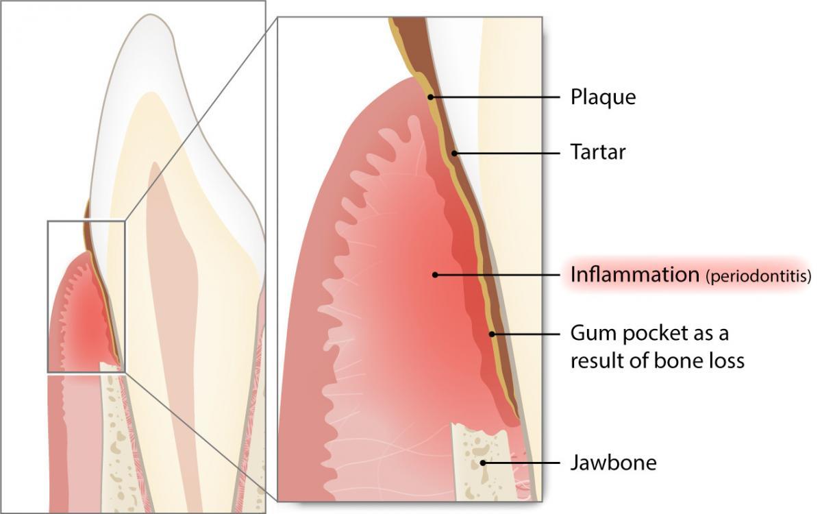 Was ist die Parodontitis und wie häufig kommt sie vor?