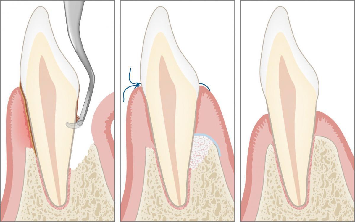 Chirurgische Weiterbehandlung