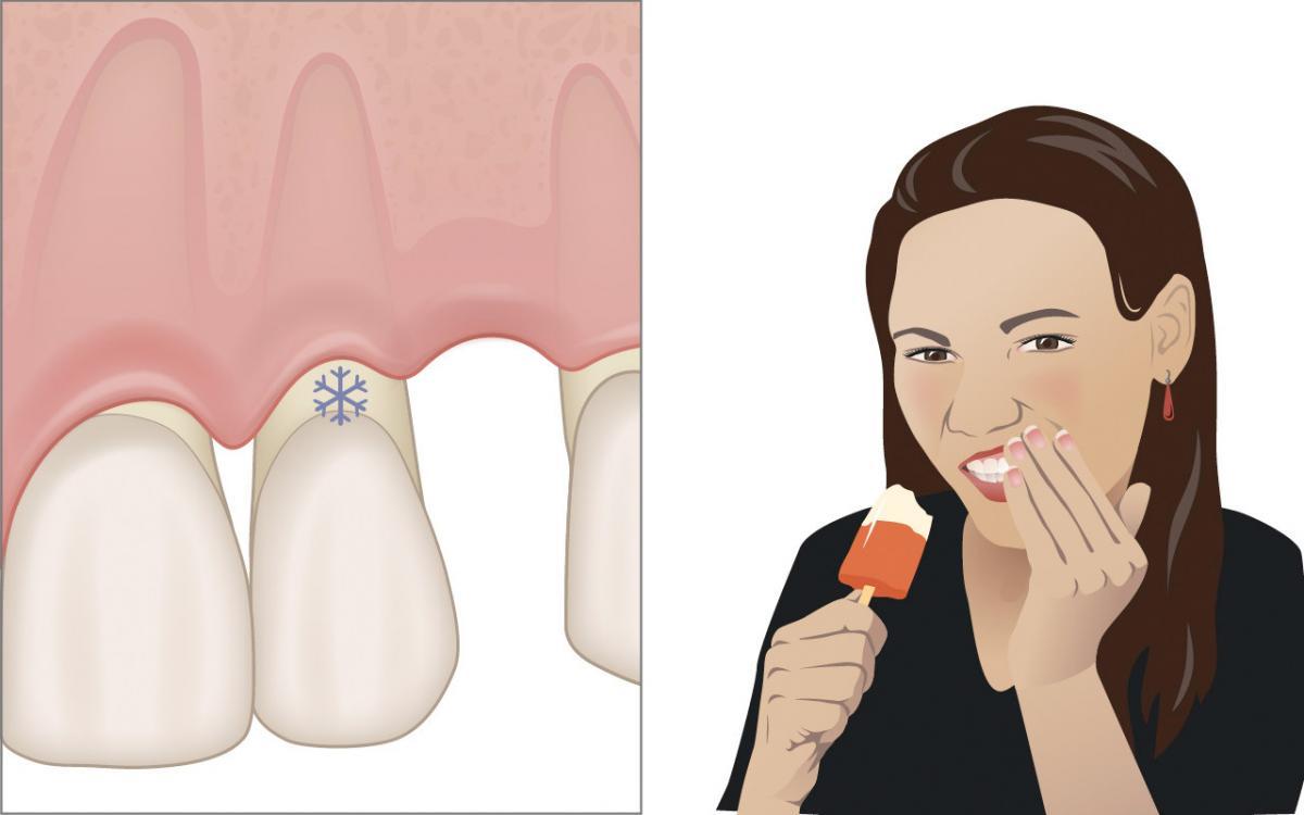 Mögliche Nebenwirkungen einer parodontalen Behandlung
